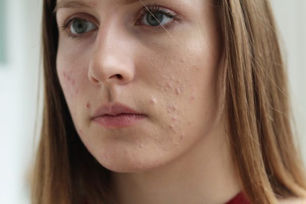 stress Acne
