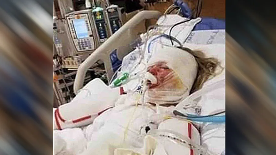 Six-year-old Kenzie from Indiana suffered burns to 68 percent of her body after a candle fell on a sofa and caused fire in the neighboring apartment, on Dec. 16, 2018. (Jada Haughey /GoFundMe)