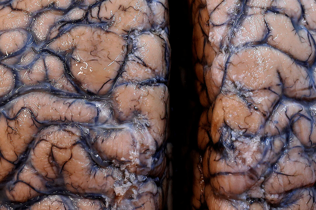 A human brain is seen at the psychiatric hospital in Duffel, Belgium, July 19, 2017. (Yves Herman/Reuters)