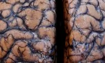 Rare Brain-Eating Amoeba Infection Confirmed in a Man in Florida
