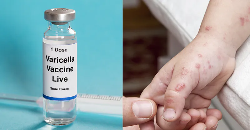 Childhood Shingles Resulting from Chickenpox Vaccination: “Rare” or Predictable?