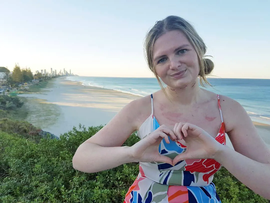 Ludwig's angina survivor Caitlin Alsop on the Gold Coast, Australia, on Aug. 19, 2018. (Caitlin Alsop/Facebook)