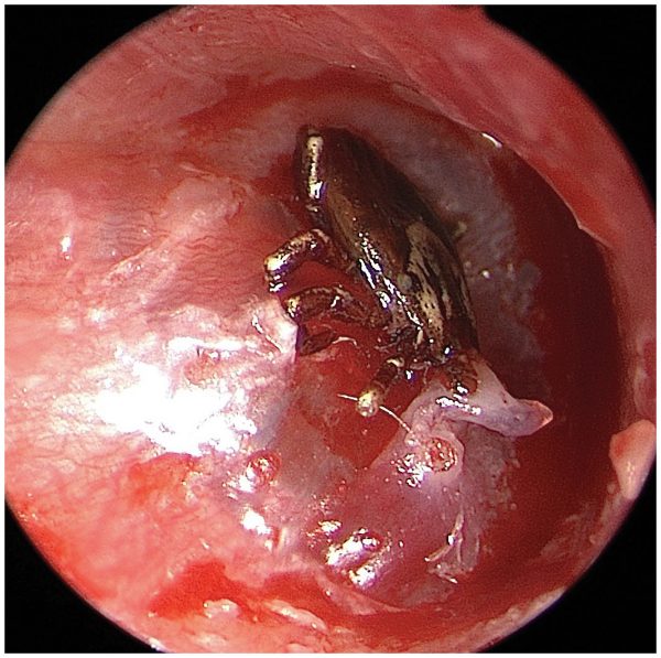 this tick was found in a boy's ear