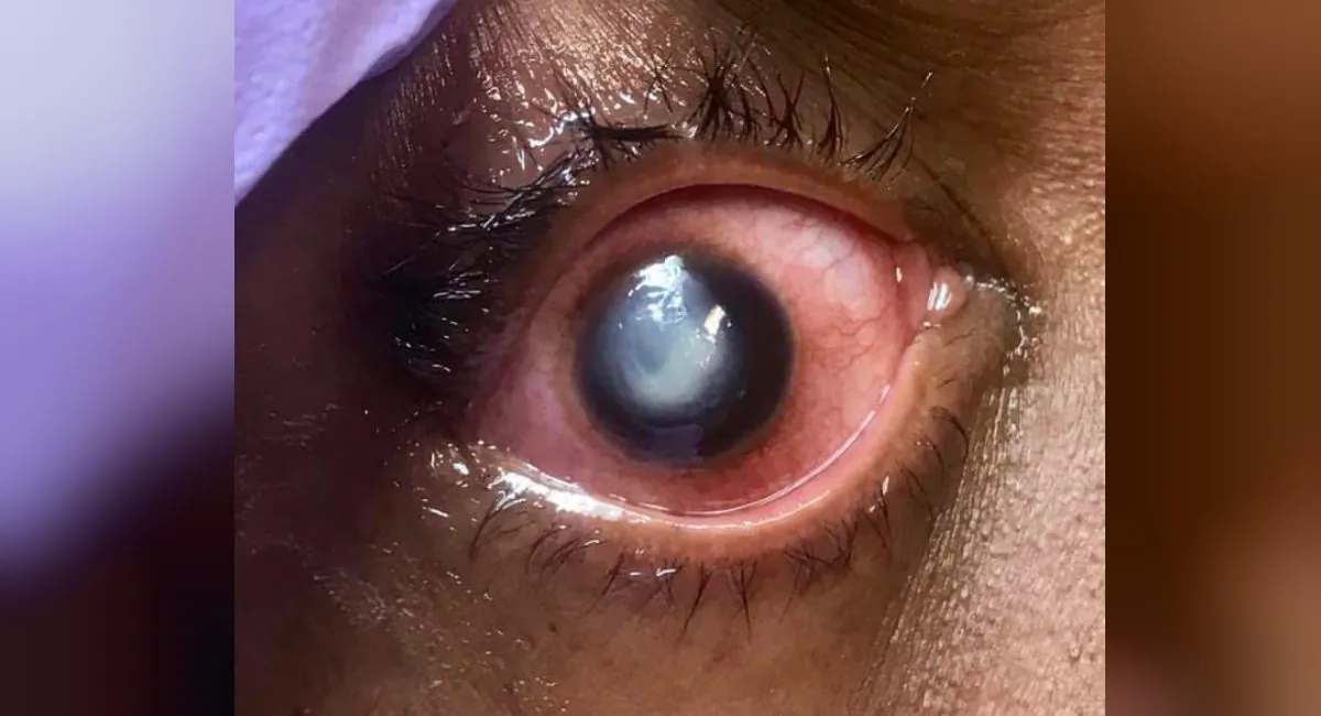 The eye of a patient suffering from pseudomonas infection of the cornea. (Vita Eye Clinic)
