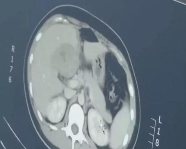 Ectopic pregnancy liver