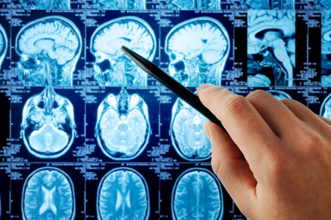 An estimated 300,000 people world-wide were diagnosed with a primary brain tumour in 2020.(Illustration -Shutterstock)
