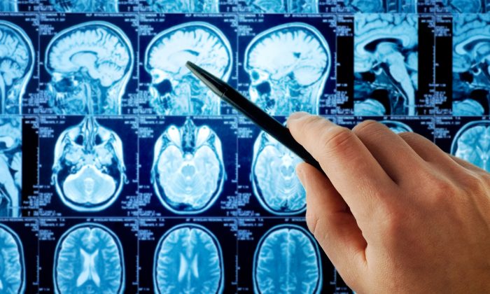 An estimated 300,000 people world-wide were diagnosed with a primary brain tumour in 2020.(Illustration -Shutterstock)
