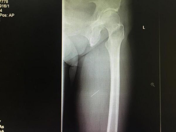 Needle woman leg