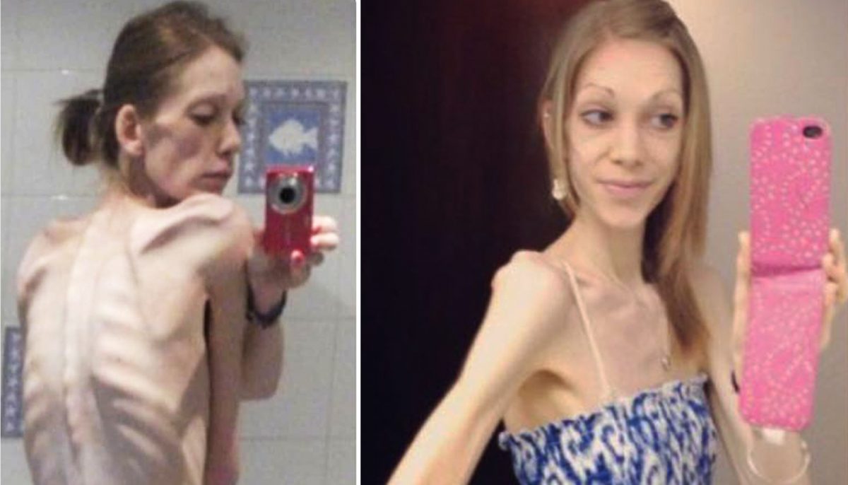 On The Brink Of Death Anorexic Teen Weighed 55lb But Bodybuilding 