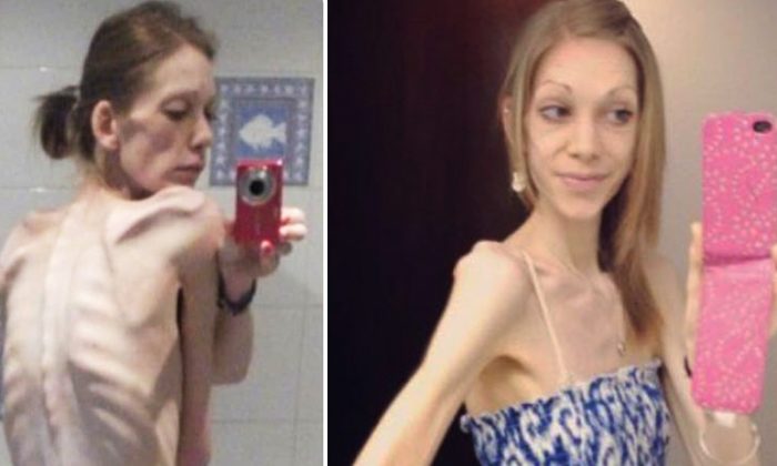 On The Brink Of Death Anorexic Teen Weighed 55lb – But Bodybuilding