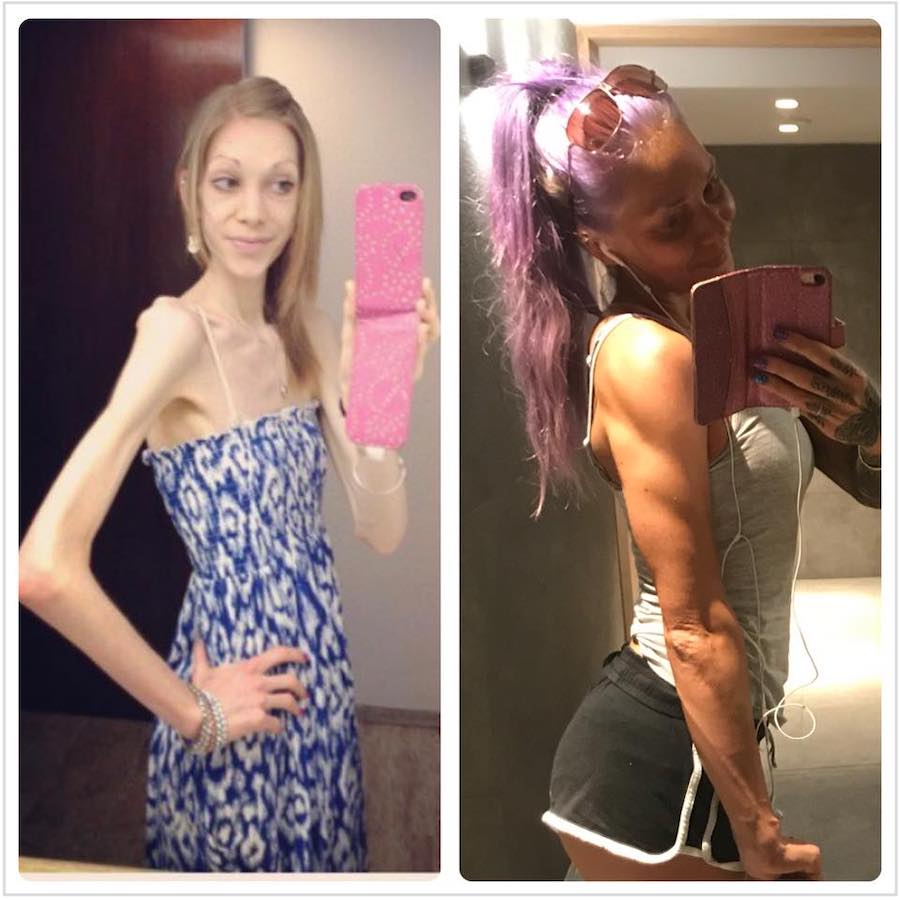 On the Brink of Death, Anorexic Teen Weighed 55lb - but Bodybuilding Saved ...