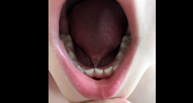 A tongue-tie (Gzzz via Creative Commons Attribution-Share Alike 4.0 International license.)
