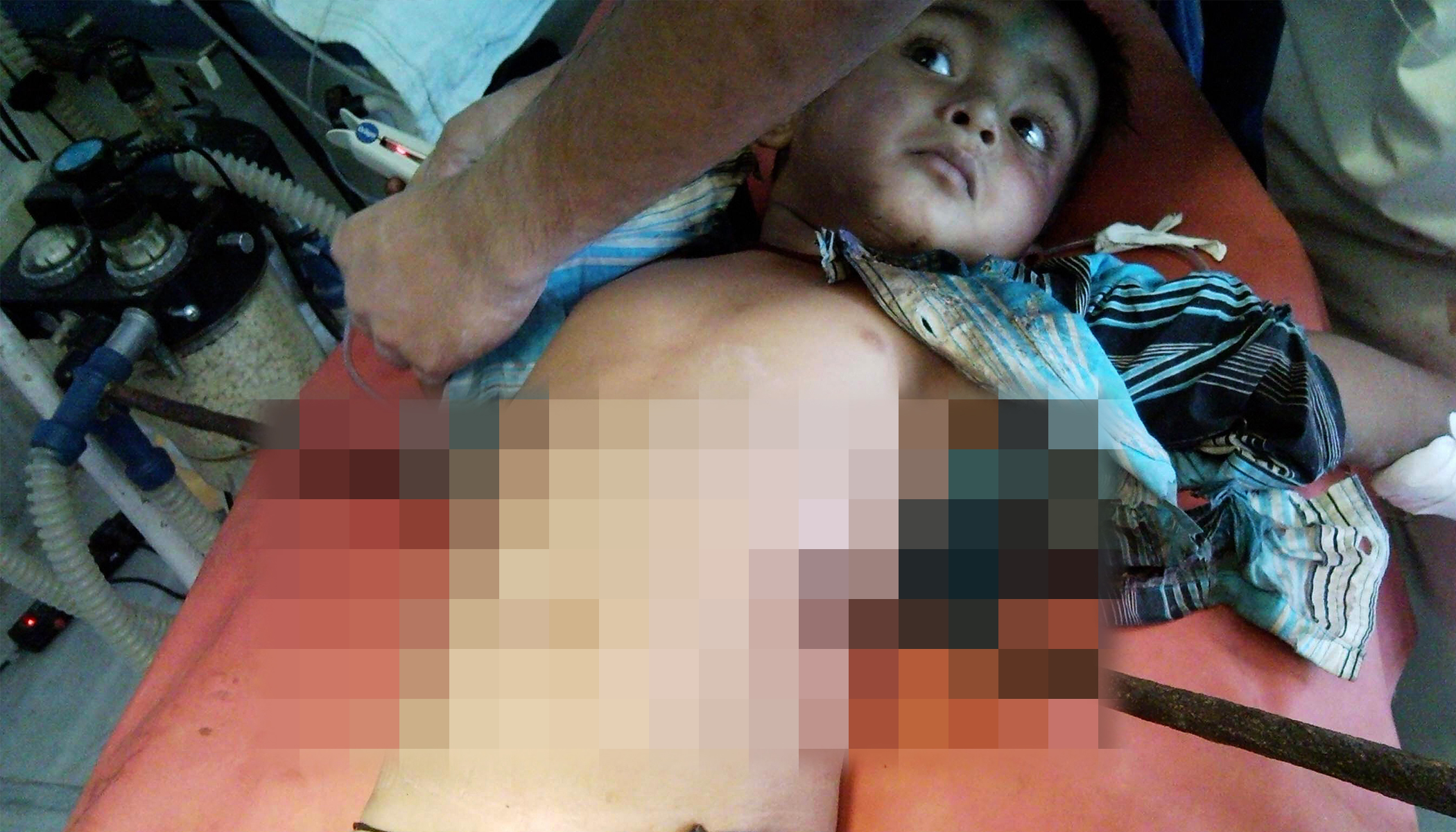 3-Year-Old Miraculously Survives After Falling on Iron Rod T