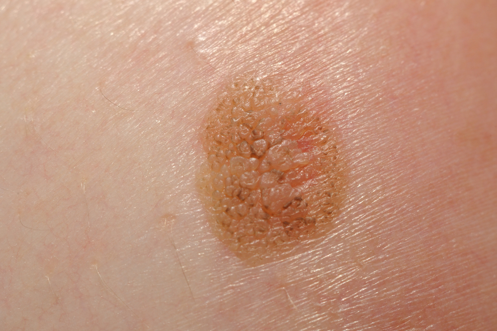 melanoma cancerous skin tags pictures