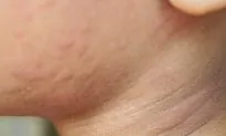 Mom Cures Daughter’s Severe Eczema With Fruit and Veg Miracle Raw Diet