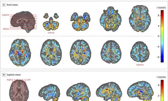 US Diplomats’ Brain Scans Show Differences, Adding to Cuba Mystery