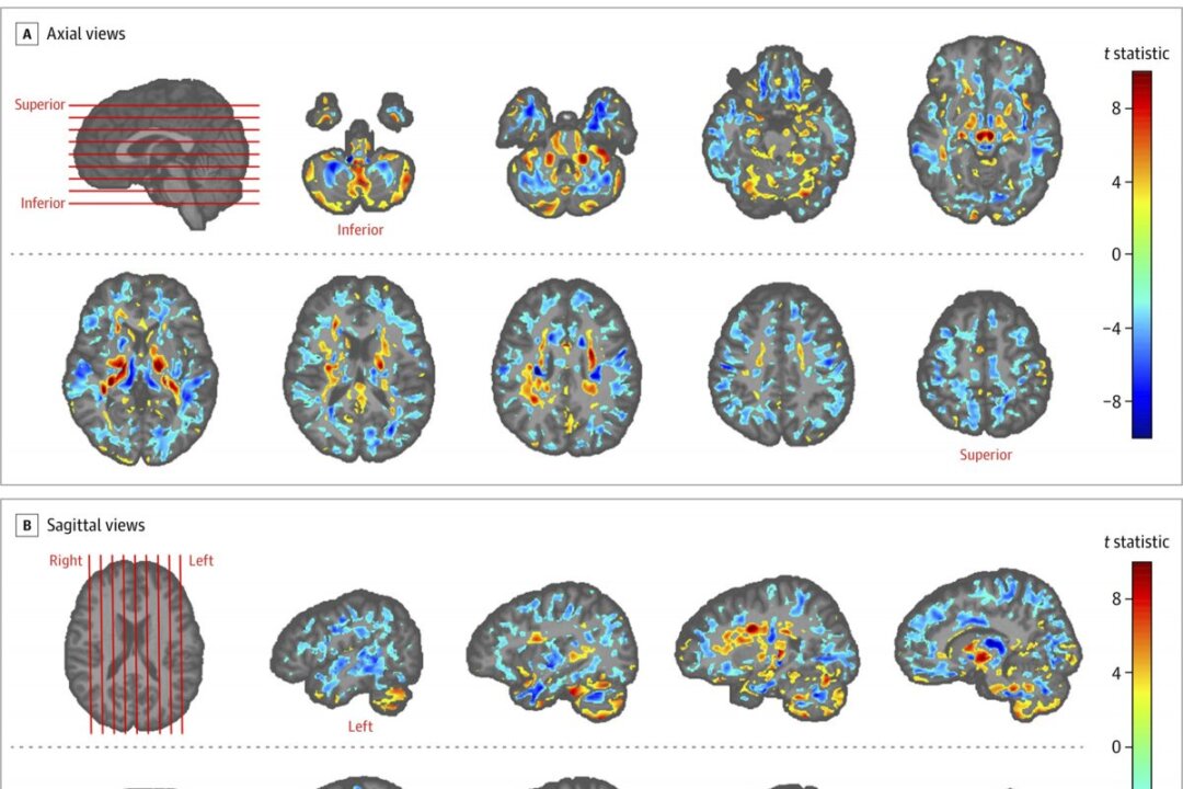 This image provided by the American Medical Association shows the amount of differences between brain scans of patients, in July 2019. (American Medical Association via AP)