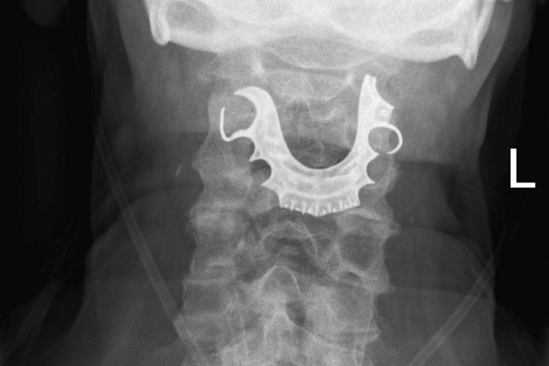 This undated X-ray image provided by the BMJ in August 2019 shows dentures stuck in the throat of a 72-year-old patient. They became lodged in his throat during surgery and weren’t discovered until eight days later. (BMJ via AP)
