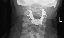 A Man’s False Teeth Got Stuck in His Throat During a Surgery, 8 Days Passed Before Anyone Noticed
