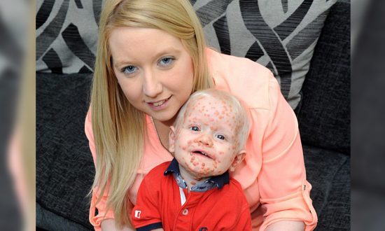 Baby Is Born With Chicken Pox-Like Lumps, but It Turns Out to Be 1-in-100,000 Disease