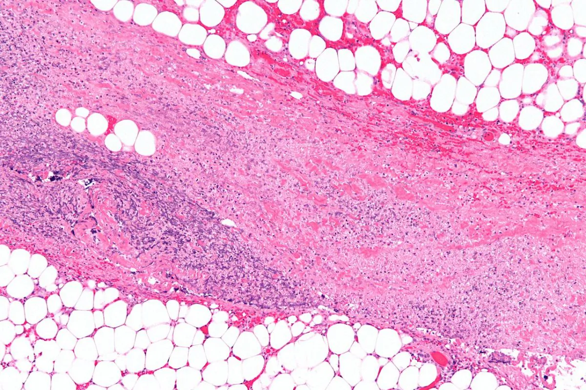 A microscopic photograph of necrotizing fasciitis bacteria. (Copyright © 2011 Michael Bonert/ CC BY-SA 3.0)