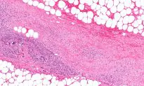 Florida Man Who Had 25 Percent of Skin Removed Dies From Flesh-Eating Bacteria