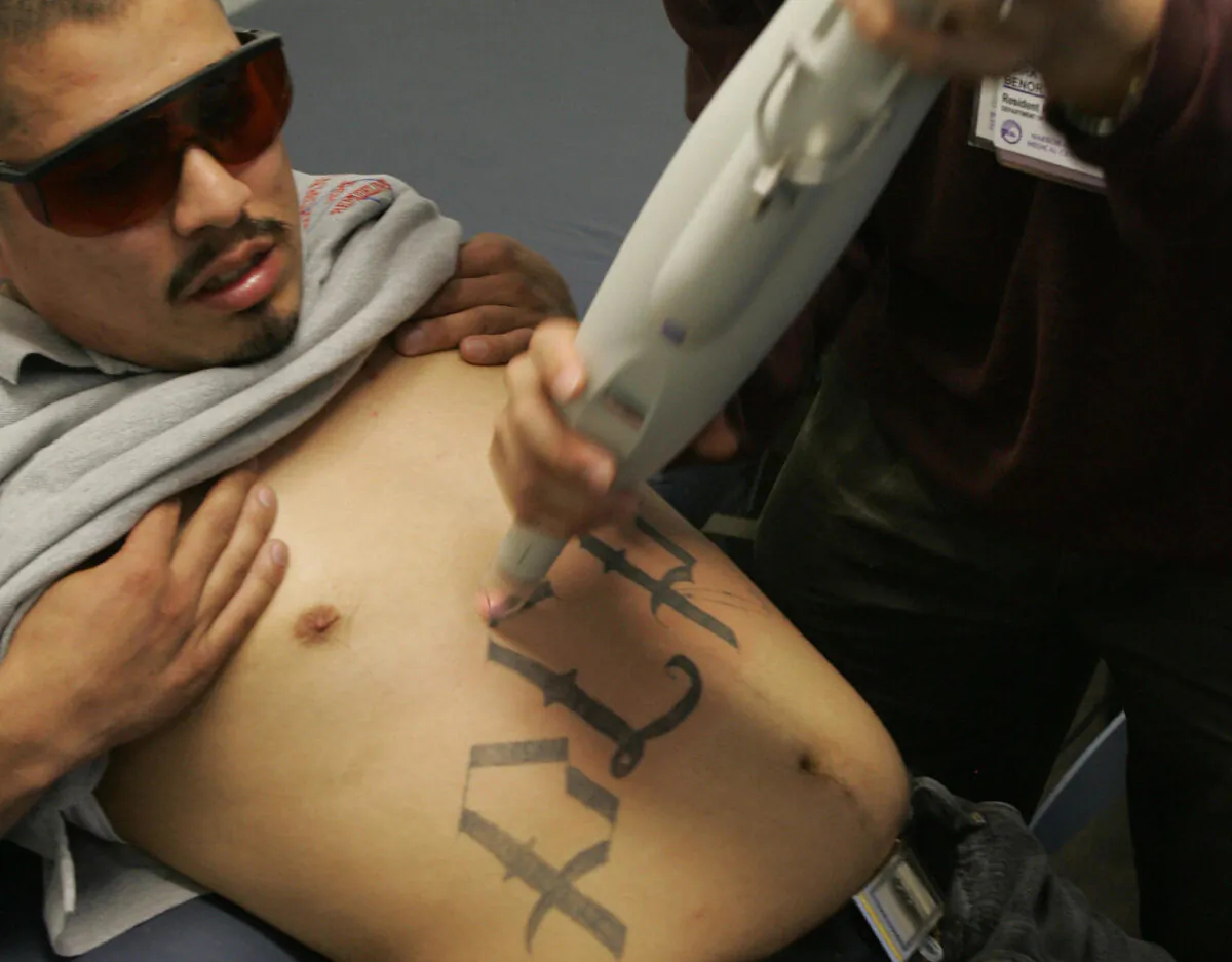 A doctor uses a laser machine to begin tattoo removal on a former gang member at a tattoo removal clinic in East Los Angeles on March 23, 2005. (Robyn Beck/AFP/Getty Images)