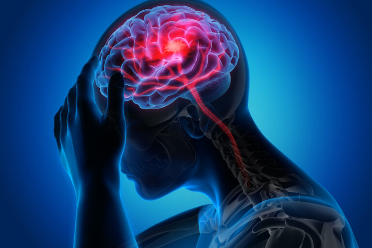 Warning Signs of Stroke Could Appear as Early as 1 Month Prior