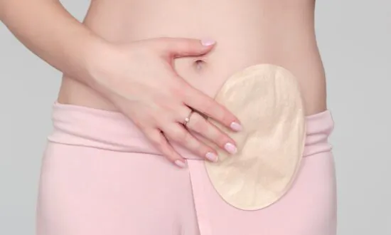My Experience Living With an Ileostomy
