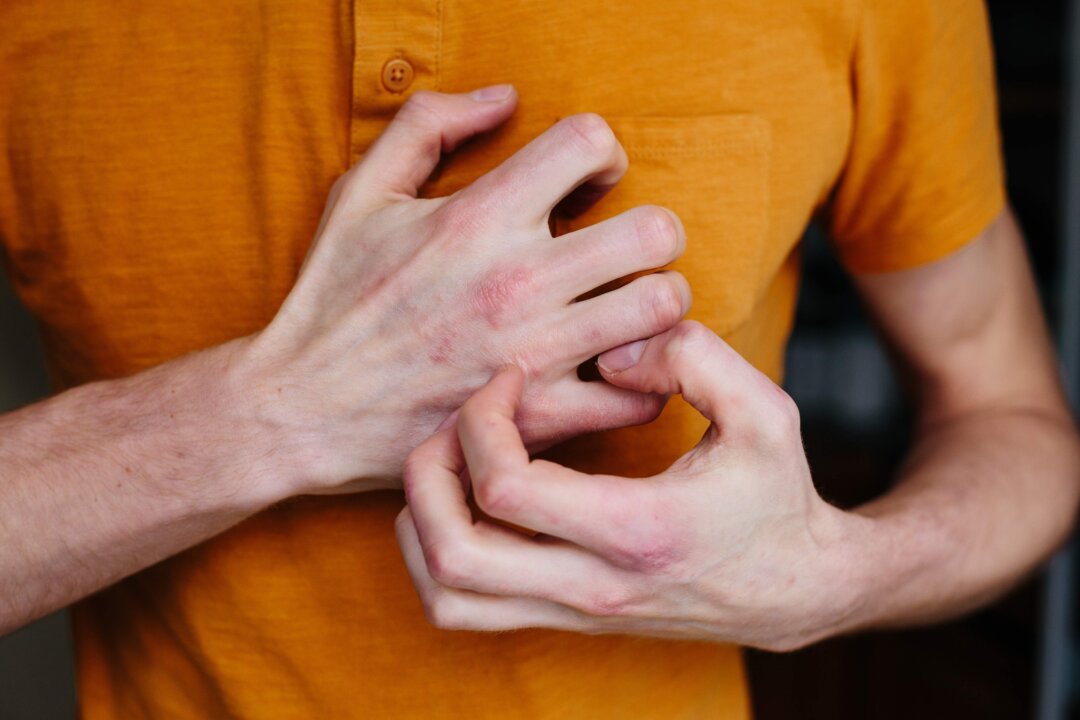 Autoimmune conditions can range from rashes to debilitating illness. (Ternavskaia Olga Alibec/Shutterstock)