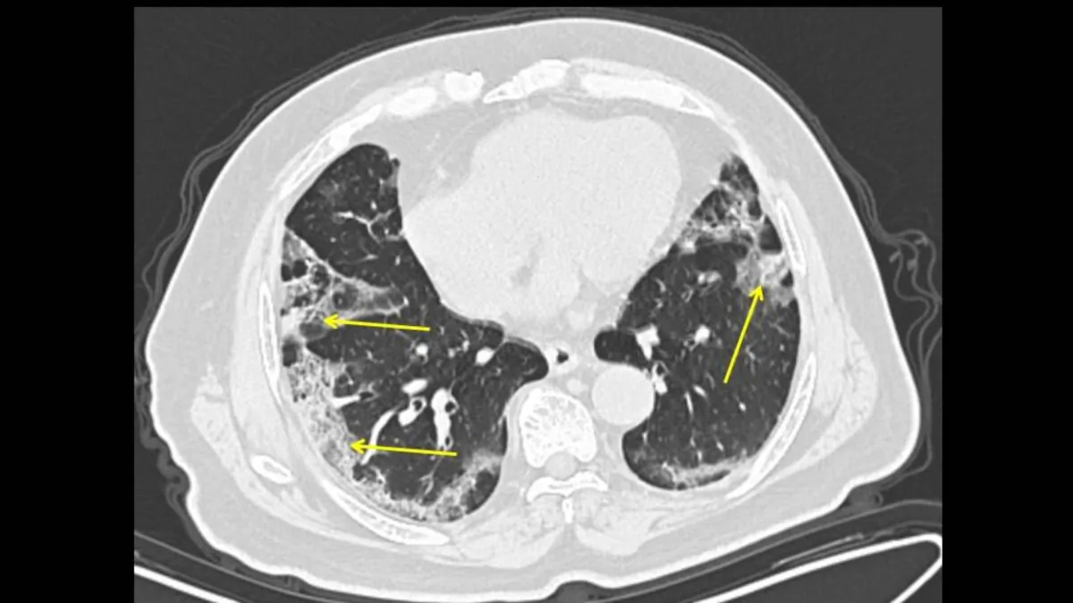 A 65-year-old male with a history of travel to Wuhan, presenting with fever and cough. CT scan obtained 11 days from onset of symptoms (late group) shows moderate lung disease with peripheral ground glass opacities in the lungs (arrows). (The Mount Sinai Hospital)

