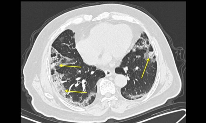 A 65-year-old male with a history of travel to Wuhan, presenting with fever and cough. CT scan obtained 11 days from onset of symptoms (late group) shows moderate lung disease with peripheral ground glass opacities in the lungs (arrows). (The Mount Sinai Hospital)

