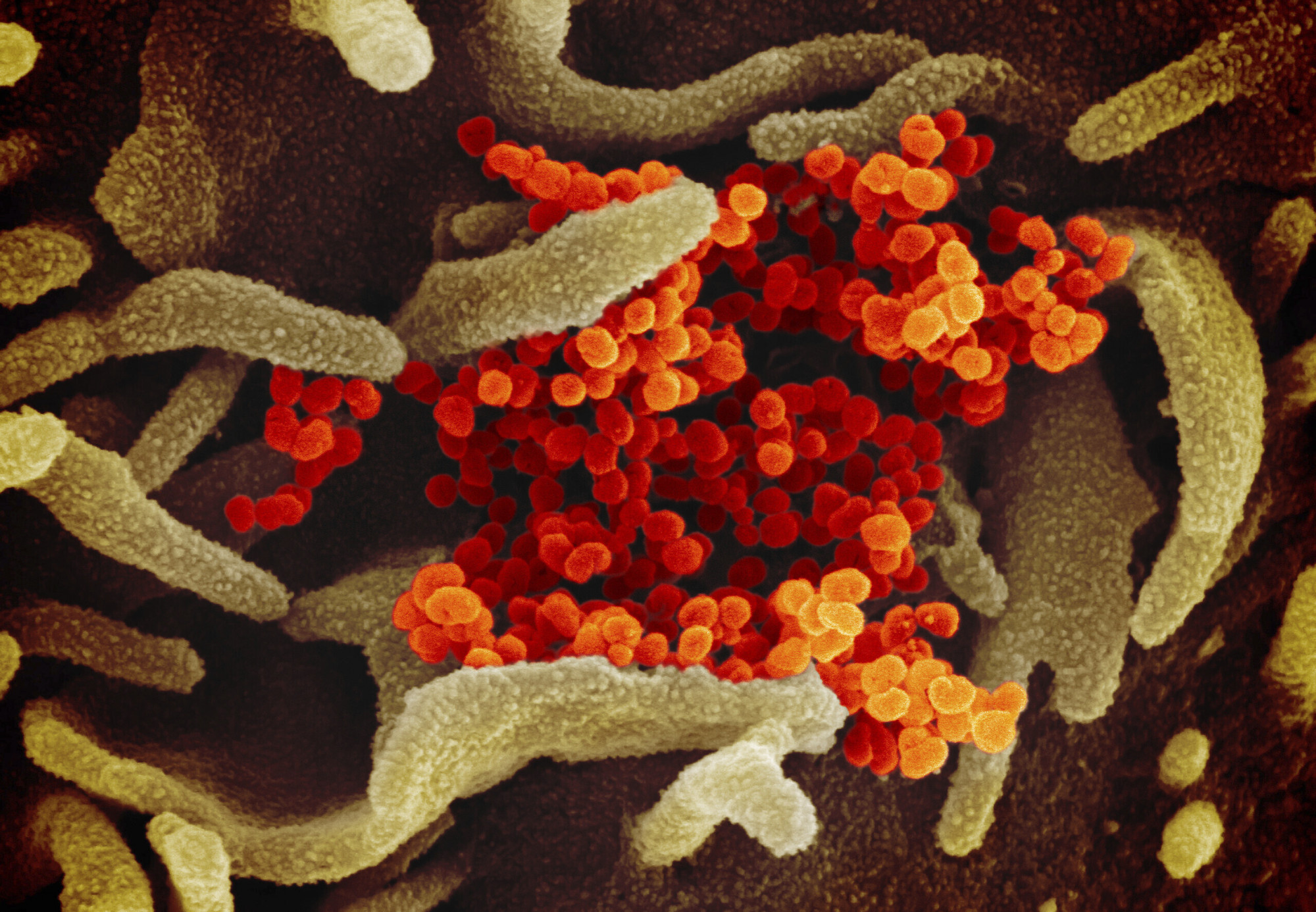 This scanning electron microscope image shows SARS-CoV-2