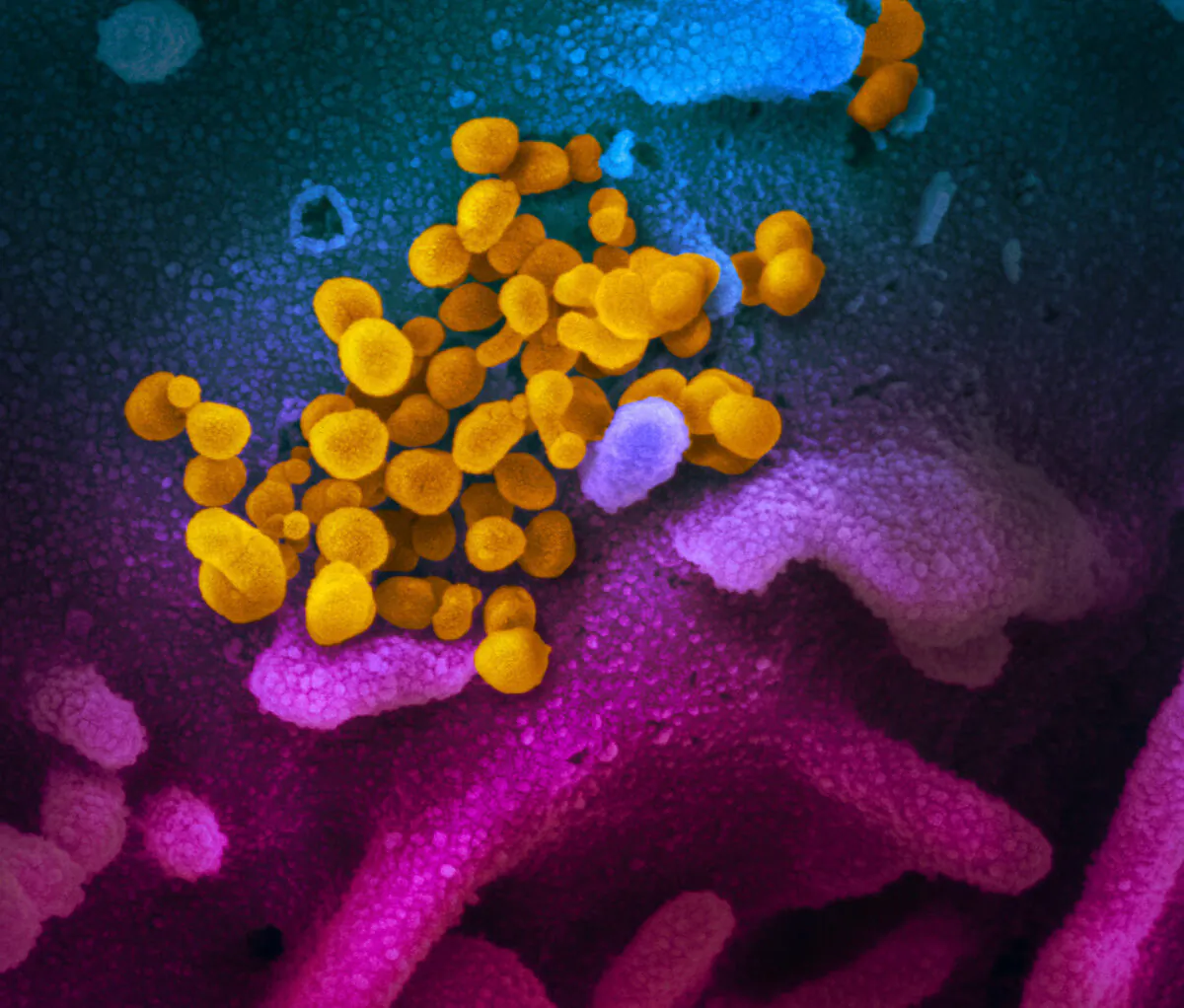 This scanning electron microscope image, published on Feb. 13, 2020, shows SARS-CoV-2 (yellow)—also known as the CCP virus—the virus that causes COVID-19, isolated from a patient in the U.S., emerging from the surface of cells (blue/pink) cultured in the lab. (Courtesy of NIAID-RML)