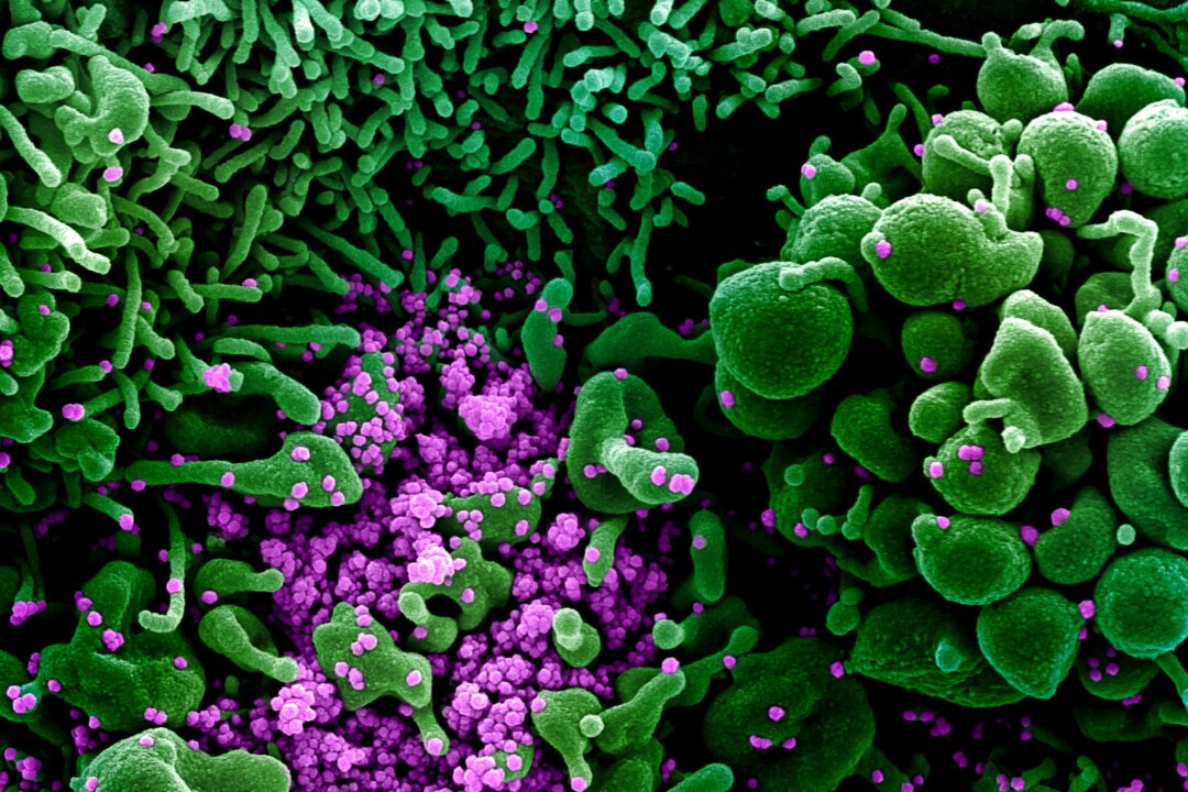 Colorized scanning electron micrograph of cell (green) heavily infected with COVID-19 particles (purple), commonly known as SARS-CoV-2 or novel CCP virus, isolated from a patient sample on March 16, 2020. (NIAID)