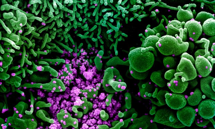 Colorized scanning electron micrograph of cell (green) heavily infected with CCP virus particles (purple), commonly known as SARS-CoV-2 or novel CCP virus, isolated from a patient sample on March 16, 2020. (NIAID)