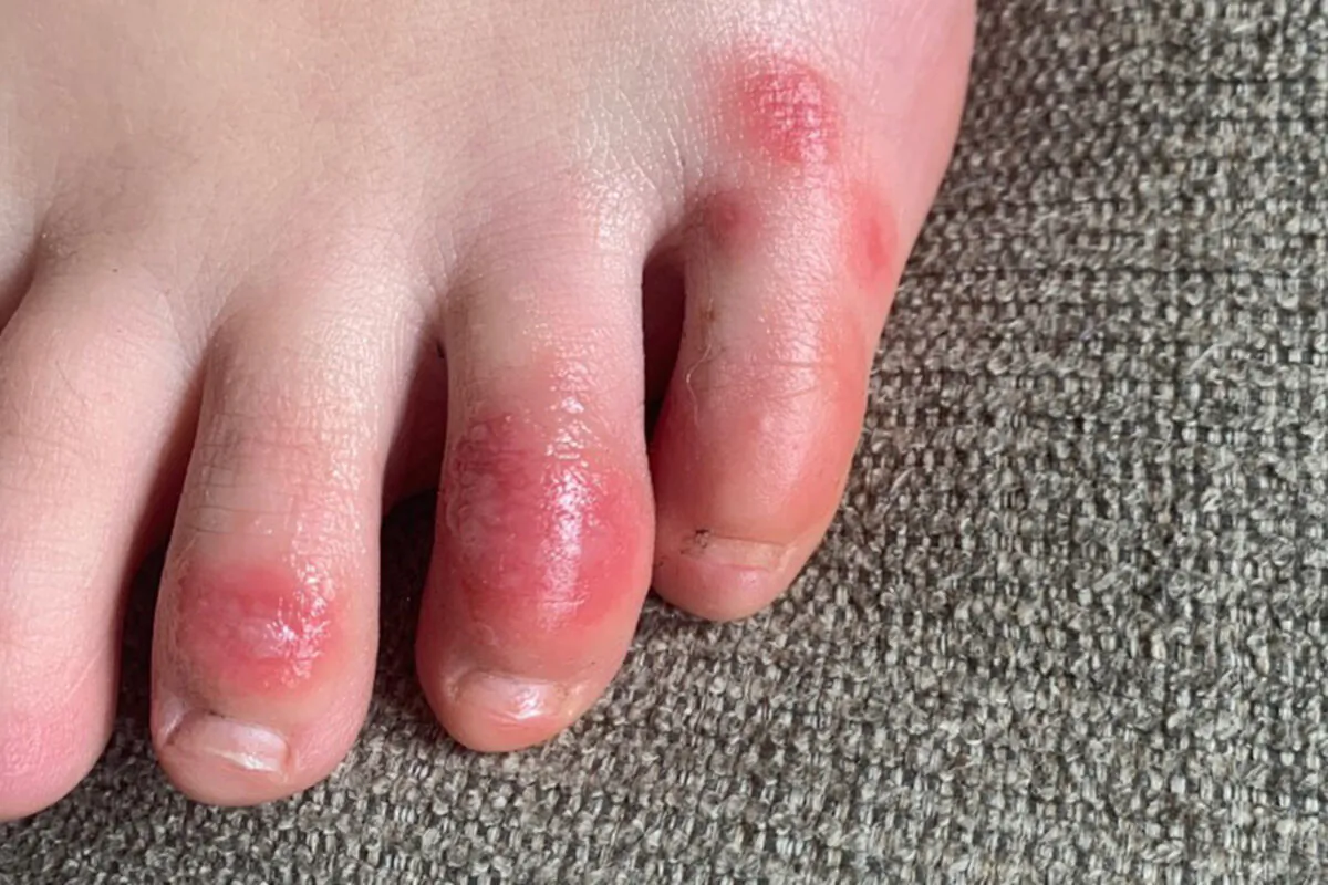 Discoloration on a teenage patient's toes at the onset of the condition informally called "COVID toes" on April 3, 2020. (Courtesy of Dr. Amy Paller/Northwestern University via AP)