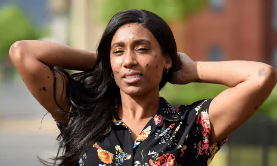 Bullies Called Her ‘Dalmatian’ Because of Her Skin Condition–Then She Became a Model