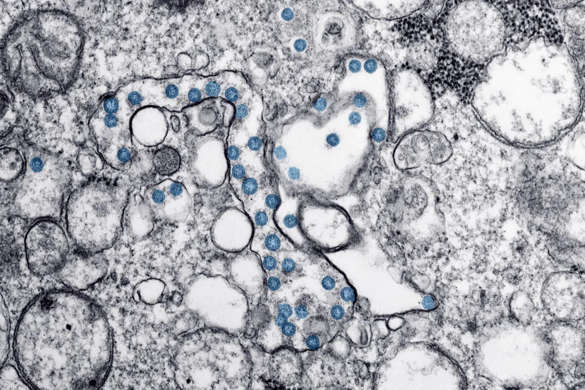 This 2020 electron microscope image made available by the U.S. Centers for Disease Control and Prevention shows the spherical particles of the new coronavirus, colorized blue, from the first U.S. case of COVID-19. (AP-Hannah A. Bullock, Azaibi Tamin/CDC via AP/The Canadian Press)