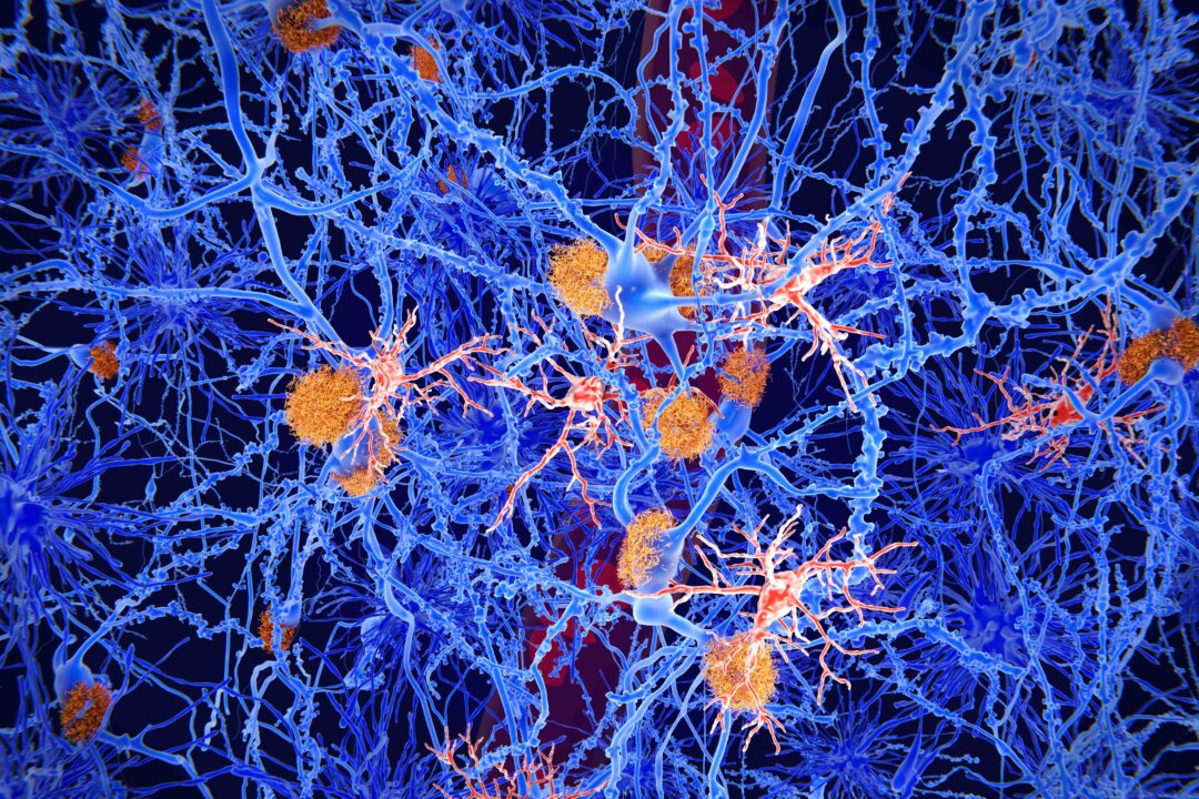 Microglia cells (red) play an important role in the pathogenesis of Alzheimer's disease. Microglia are specialised macrophages that restrain the accumulation of amyloid (orange plaques). (Juan Gaertner/Shutterstock)