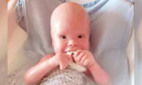 2-Year-Old With Painful Skin Condition Makes People Think He’s ‘A Doll’ but Has a ‘Wonderful Nature’