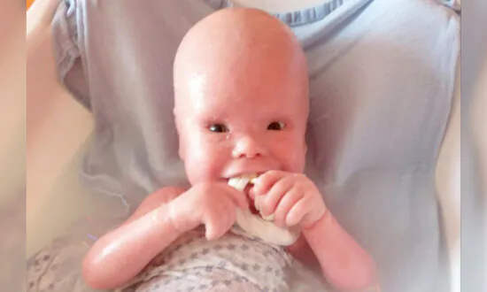 2-Year-Old With Painful Skin Condition Makes People Think He’s ‘A Doll’ but Has a ‘Wonderful Nature’