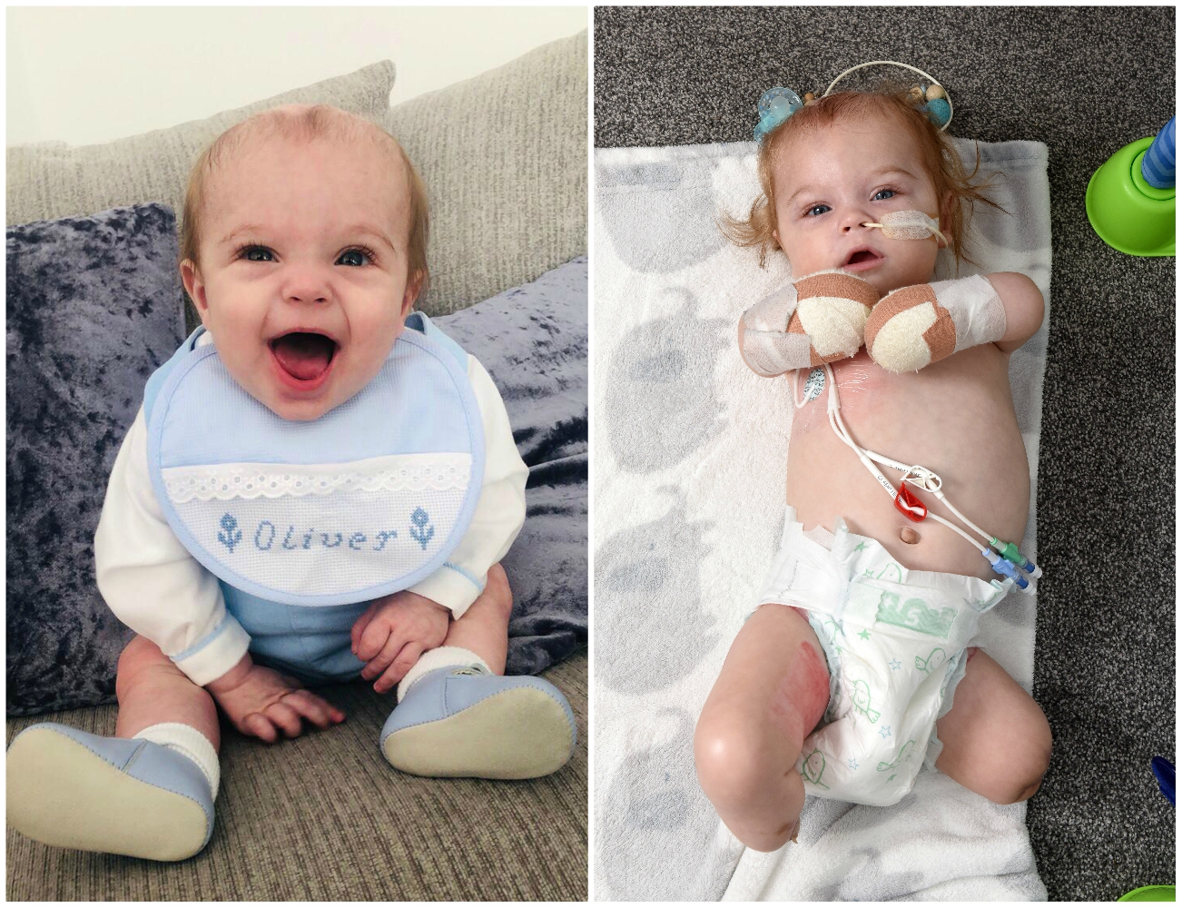 Mom Warns Parents After Baby Loses All Limbs to a Hard-to-Spot Sepsis ...