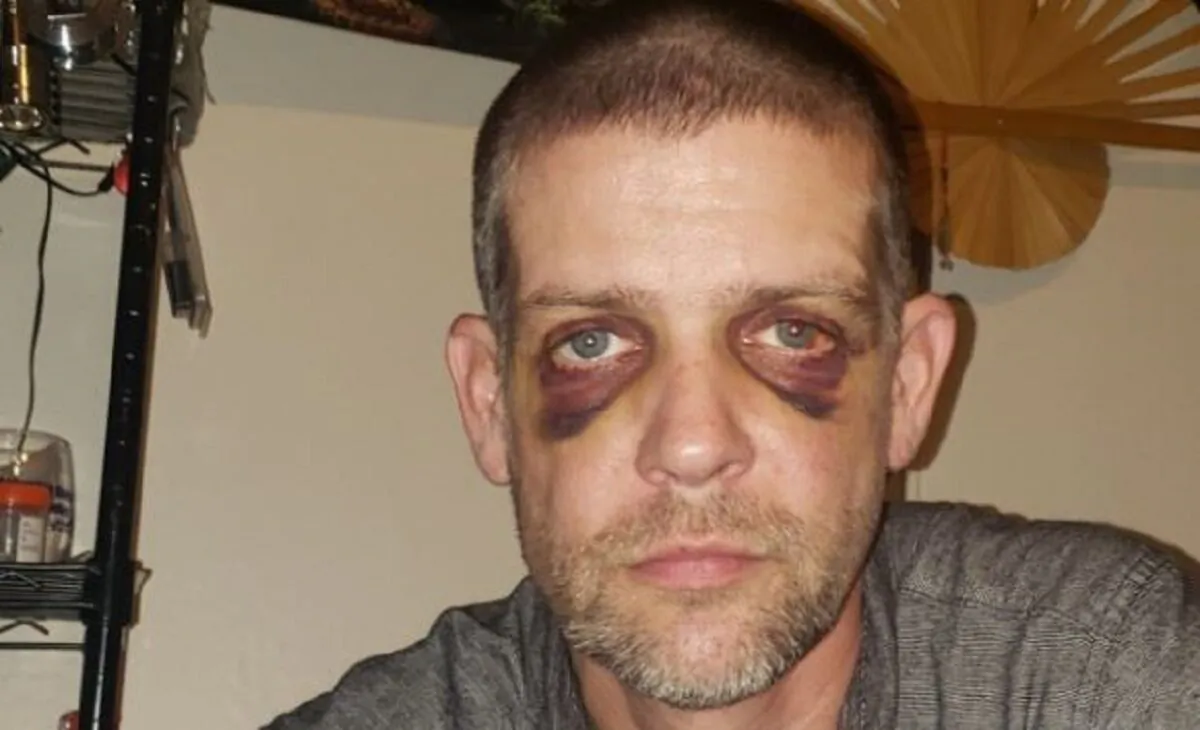 Adam Haner, who was assaulted in Portland, Ore., over the weekend, in an photograph taken on Aug. 20, 2020. (Adam Haner Fund/GoFundMe)