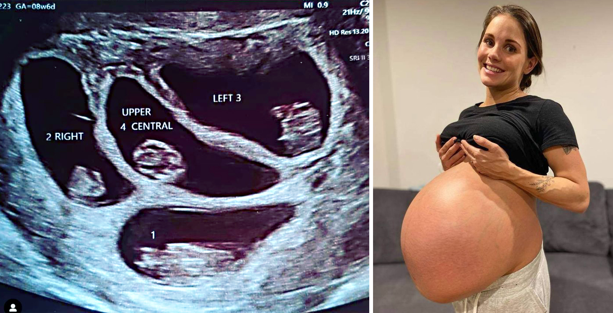 Mom Delivers Quads in High-Risk Birth After Doctors Said Abort 2-3 Babies