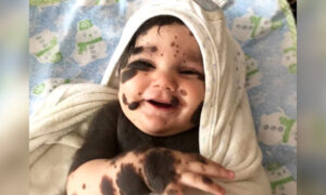 Parents Refuse to Give Up Newborn Baby Boy With 80 Percent Birthmarks