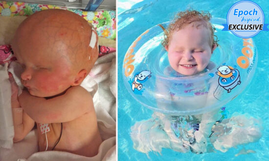 Girl Born With Two-Thirds of Her Brain Missing and No Eyeballs Defies Doctors’ Predictions