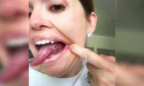 Woman Thought Sore on Her Tongue Was a Bite Mark, Until Doctor Told Her the Bad News