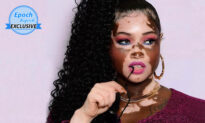 Woman With Vitiligo Was Mocked, but Became a Model, Urges: ‘It Doesn’t Matter What They Think’