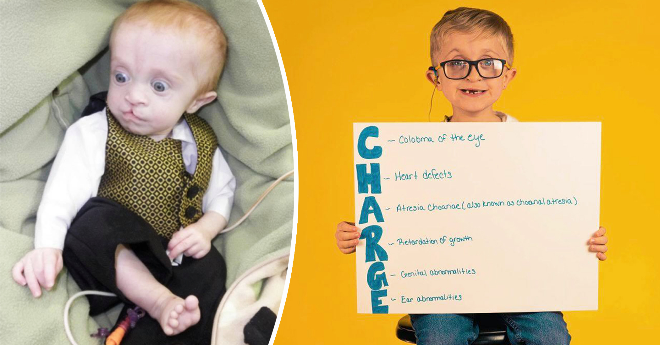 Boy With 'One in 10,000' Birth Disorder Defies Odds: 'I'm Not That Strong, I'm Just Brave' - Vimarsana News